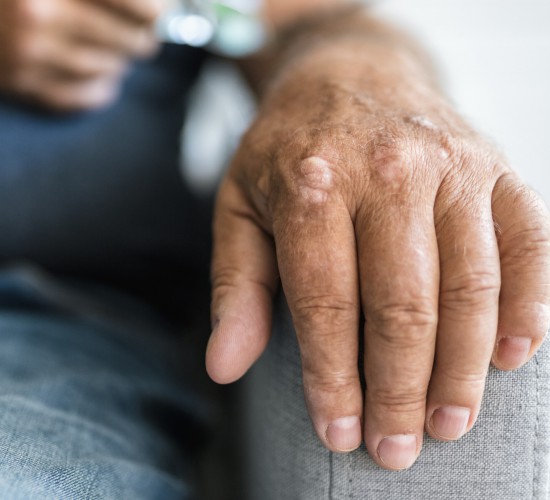 Elderly man suffering from psoriasis, closeup on hands